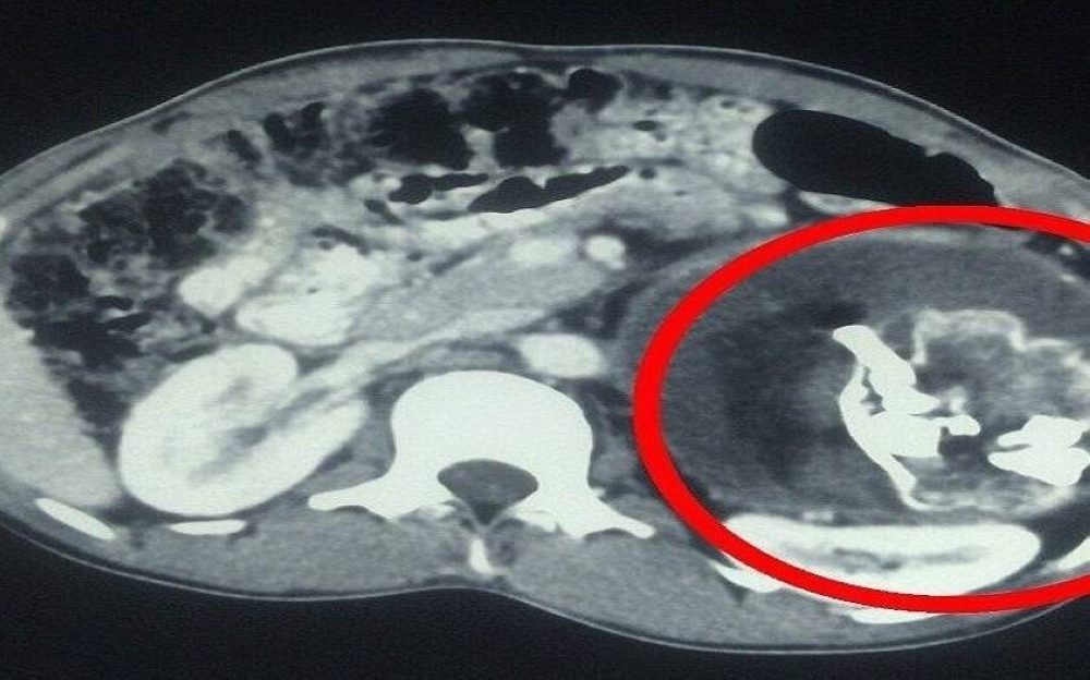 معجزة طبية.. استخراج «جنين طفيلي» من بطن رضيع