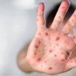 أزمة صحية في تكساس.. الحصبة تنتشر في دالاس وتثير الذعر بين السكان