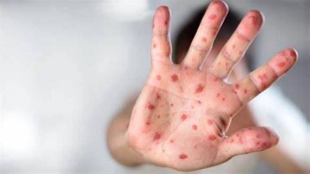 أزمة صحية في تكساس.. الحصبة تنتشر في دالاس وتثير الذعر بين السكان
