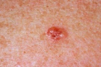 سرطان الجلد.. أسبابه وطرق علاجه