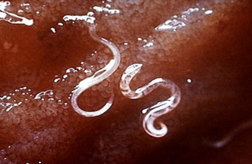 أعراض وجود الديدان في الجسم أعراض وجود الديدان في الجسم