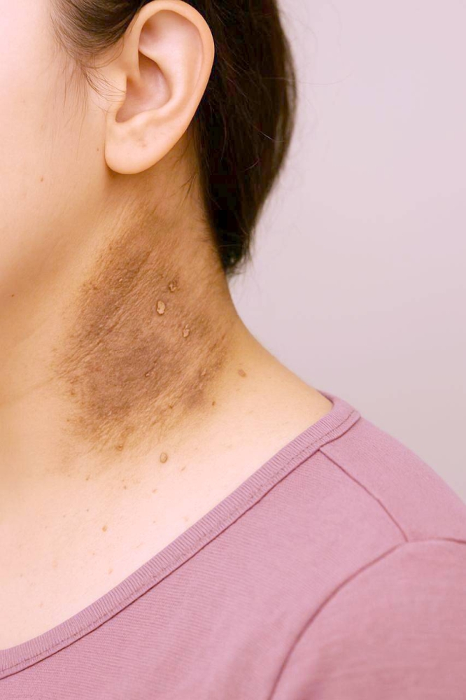 علامات خفية تنذر بالإصابة بمقاومة الأنسولين والسكري علامات خفية تنذر بالإصابة بمقاومة الأنسولين والسكري