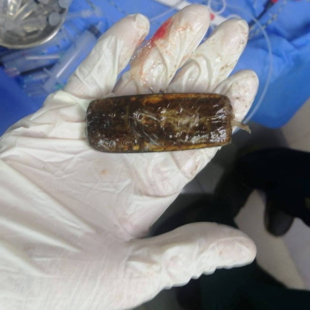 في واقعة نادرة.. استخراج هاتف محمول من بطن شاب مصري بعد عامين من ابتلاعه في واقعة نادرة.. استخراج هاتف محمول من بطن شاب مصري بعد عامين من ابتلاعه