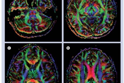 دراسة أسترالية تكشف: دماغ اللاعب يتغيّر بعد دقائق من ضرب الكرة بالرأس