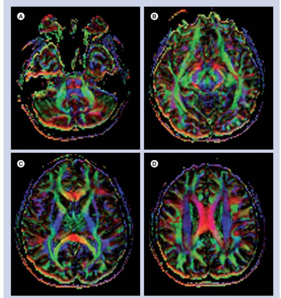 دراسة أسترالية تكشف: دماغ اللاعب يتغيّر بعد دقائق من ضرب الكرة بالرأس دراسة أسترالية تكشف: دماغ اللاعب يتغيّر بعد دقائق من ضرب الكرة بالرأس