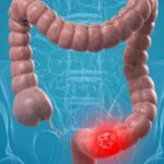 إستراتيجية جديدة لمكافحة سرطان القولون