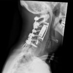 الحسين للسرطان يجري عملية نوعية لاستئصال ورم عنقي