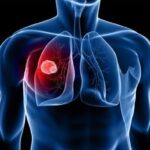 السويد تخفض وفيات سرطان الرئة بنسبة 42% خلال عقد واحد