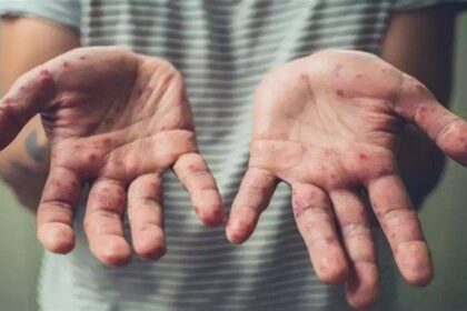 غينيا تواجه موجة جديدة.. 18 إصابة بجدري القردة تثير القلق الصحي