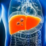 دراسة: 60% من حالات سرطان الكبد يمكن الوقاية منها