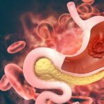 العامل الرئيسي لتطور سرطان المعدة