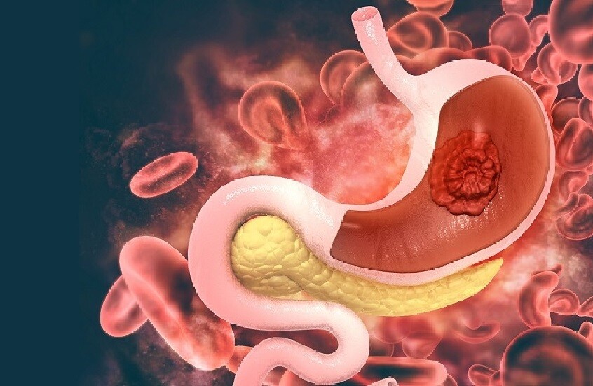 العامل الرئيسي لتطور سرطان المعدة العامل الرئيسي لتطور سرطان المعدة