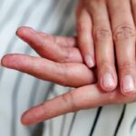 أسباب حرقة اليدين