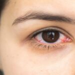 احمرار العين.. بين الأسباب البسيطة والمؤشرات الخطيرة