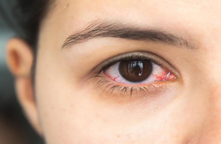 احمرار العين.. بين الأسباب البسيطة والمؤشرات الخطيرة احمرار العين.. بين الأسباب البسيطة والمؤشرات الخطيرة