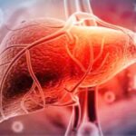 دهون الكبد.. خطر صامت بلا أعراض واضحة