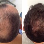 ابتكار دواء يعيد نمو الشعر في أسابيع!