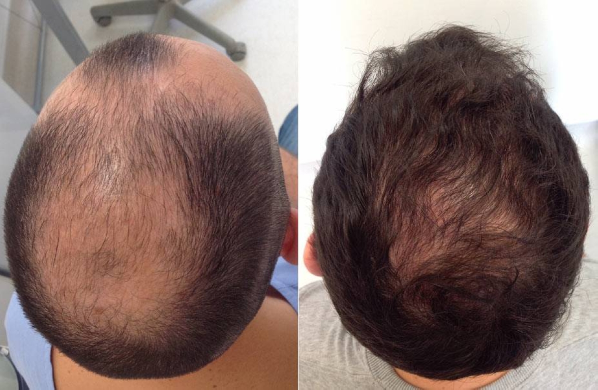 ابتكار دواء يعيد نمو الشعر في أسابيع! ابتكار دواء يعيد نمو الشعر في أسابيع!