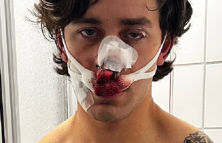 طعنات تشوه وجه عارض أزياء أمريكي أثناء دفاعه عن سيدتين طعنات تشوه وجه عارض أزياء أمريكي أثناء دفاعه عن سيدتين