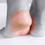 تشقق الكعب جرس إنذار صحي مبكر