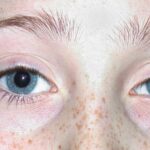 تباين حدقتي العين بين الطبيعي والمرضي