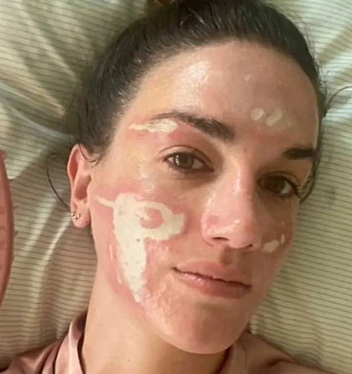 شابة تتهم خبيرة تجميل هوليوودية بتشويه وجهها إلى الأبد