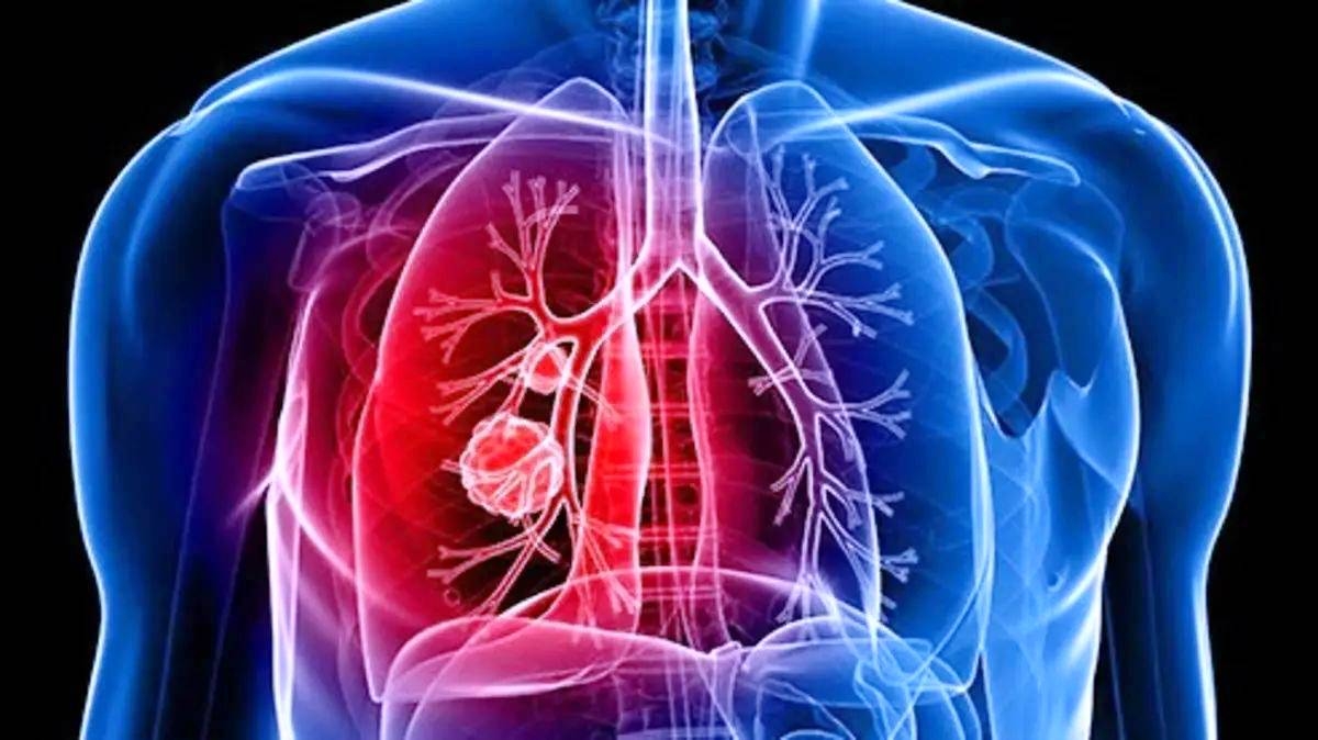 لقاح جديد مضاد للبكتيريا الرئوية لقاح جديد مضاد للبكتيريا الرئوية