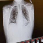 ليس التدخين فقط .. سبب آخر قد يسبب سرطان الرئة