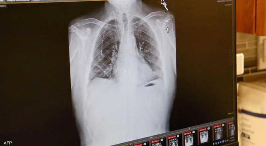 ليس التدخين فقط .. سبب آخر قد يسبب سرطان الرئة