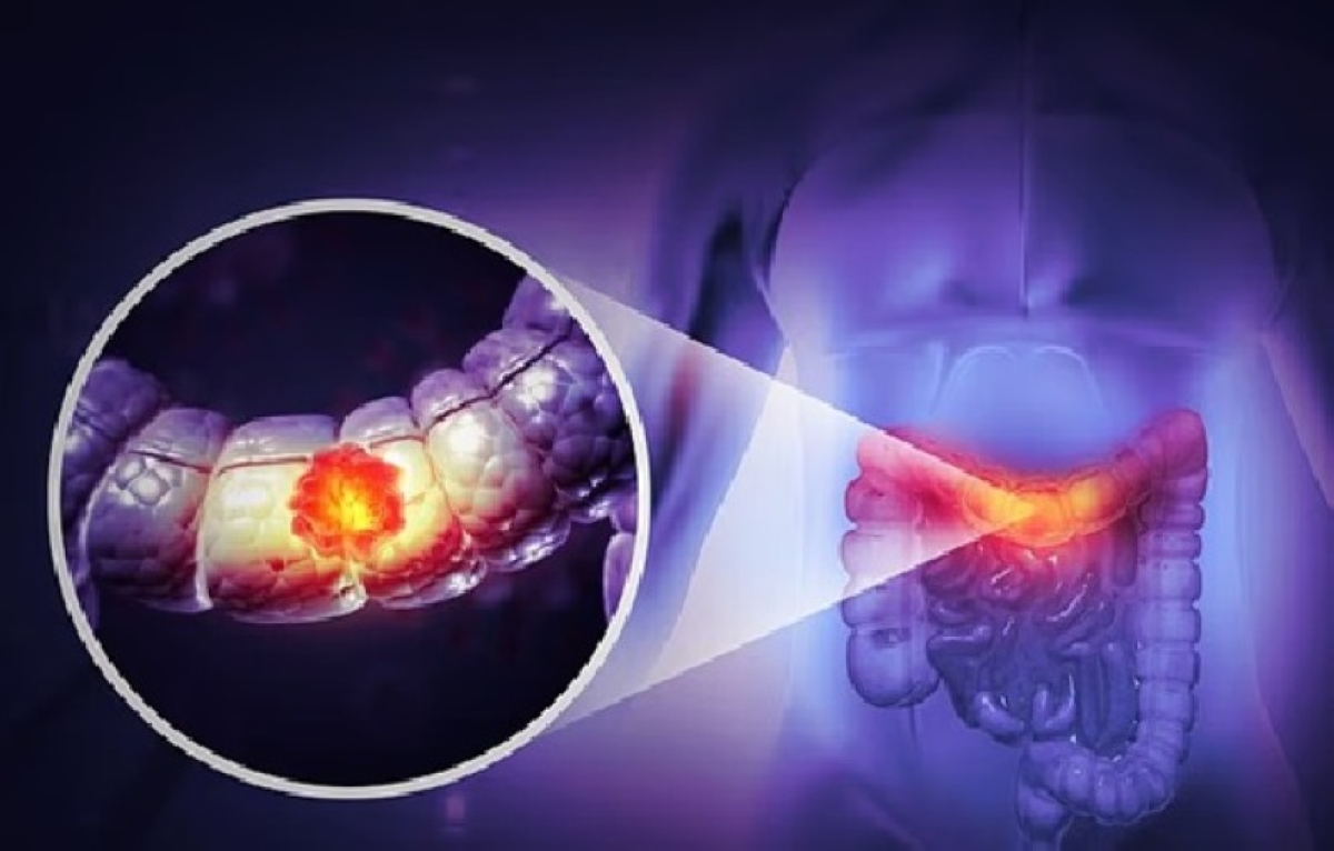 الذرة الحلوة.. حيلة بسيطة تكشف مشكلة مرتبطة بسرطان القولون الذرة الحلوة.. حيلة بسيطة تكشف مشكلة مرتبطة بسرطان القولون