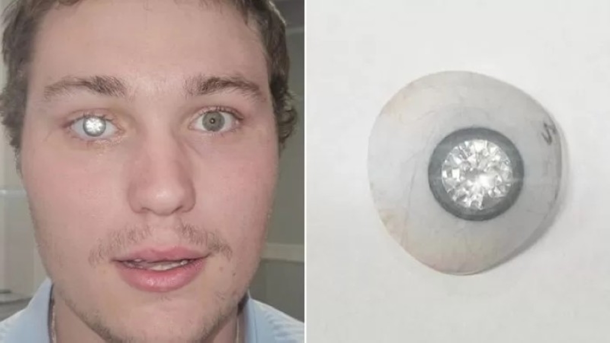 عين مرصعة بالألماس.. صائغ أمريكي يحوّل مأساته إلى تحفة فنية