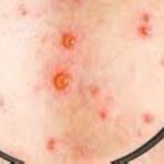 الجدري المائي يثير القلق في مدارس مصر