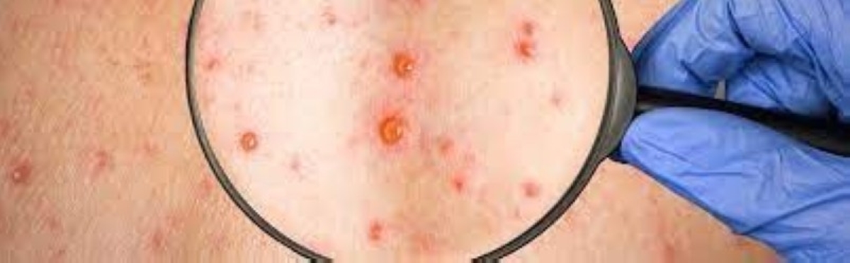 الجدري المائي يثير القلق في مدارس مصر الجدري المائي يثير القلق في مدارس مصر