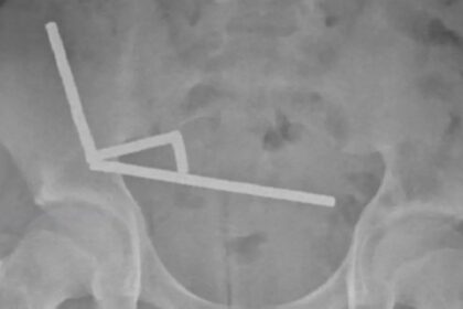 صبي ينجو من الموت بعد ابتلاع 200 مغناطيس!