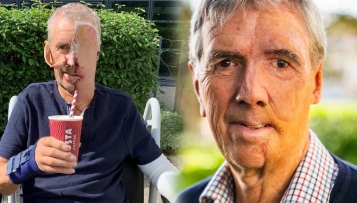 معجزة «NHS»: أول وجه مطبوع ثلاثي الأبعاد لرجل فقد ملامحه في حادثة! معجزة «NHS»: أول وجه مطبوع ثلاثي الأبعاد لرجل فقد ملامحه في حادثة!