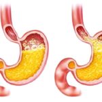 ارتجاع المريء يزيد خطر النوبات القلبية بنحو الثلث ارتجاع المريء يزيد خطر النوبات القلبية بنحو الثلث