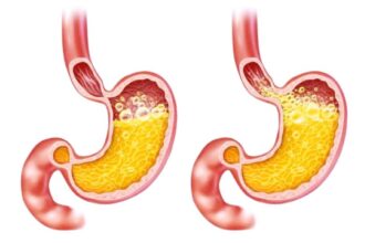 ارتجاع المريء يزيد خطر النوبات القلبية بنحو الثلث