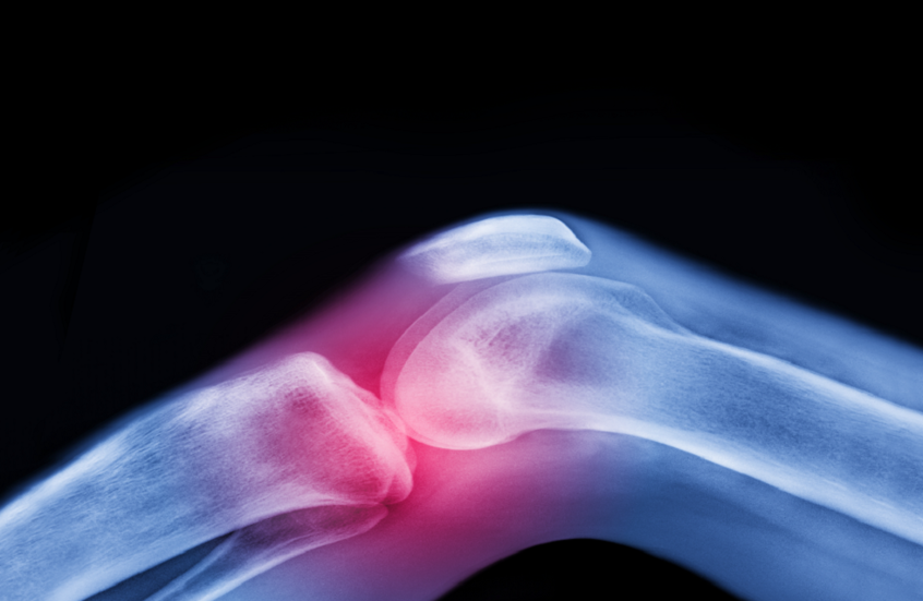 العلاج الأقوى لآلام المفاصل قبل اللجوء للأدوية والجراحة