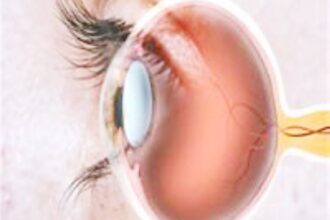 اختراق علمي.. علاج جديد يوقف فقدان البصر لمرضى السكري