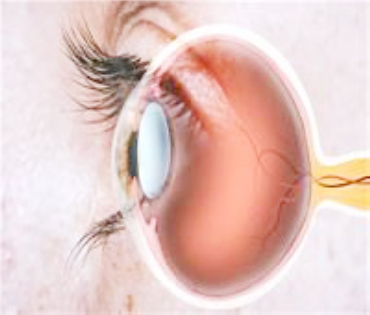 اختراق علمي.. علاج جديد يوقف فقدان البصر لمرضى السكري