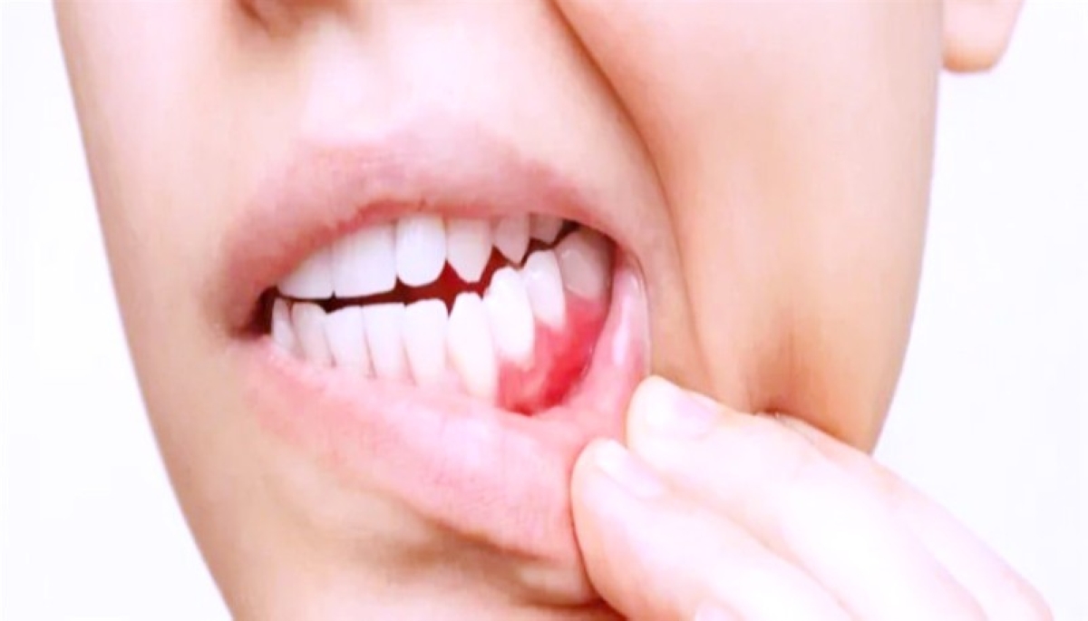عادات يومية خفية.. طريق السرطان في الفم
