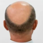 سلوكيات يوميّة قد تنقل فطريات تسبّب الصلع