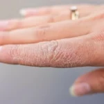 بشرتك تكشف مرض السكري.. 3 علامات لا تتجاهلها