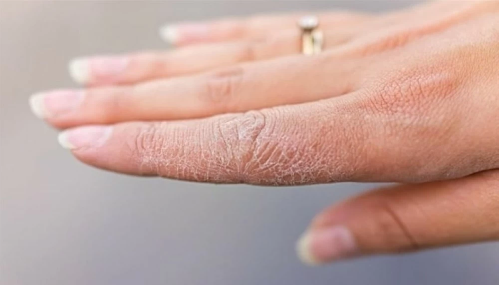 بشرتك تكشف مرض السكري.. 3 علامات لا تتجاهلها