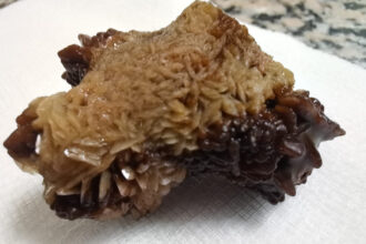 مادبا: عملية نوعية لاستخراج حصوة كبيرة من الكلى باستخدام المنظار