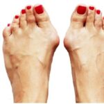 طبيب يوضح سبب تورم إبهام القدم
