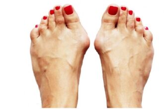 طبيب يوضح سبب تورم إبهام القدم
