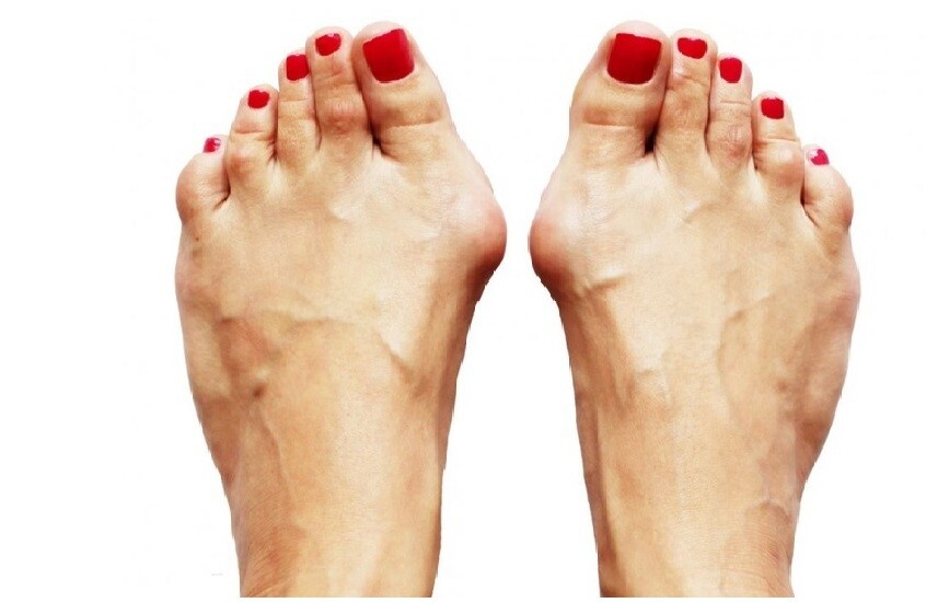 طبيب يوضح سبب تورم إبهام القدم طبيب يوضح سبب تورم إبهام القدم