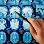 قطرات أنف مبتكرة تعالج سرطان المخ