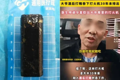 ولاعة تصمد 30 عاماً في معدة صيني